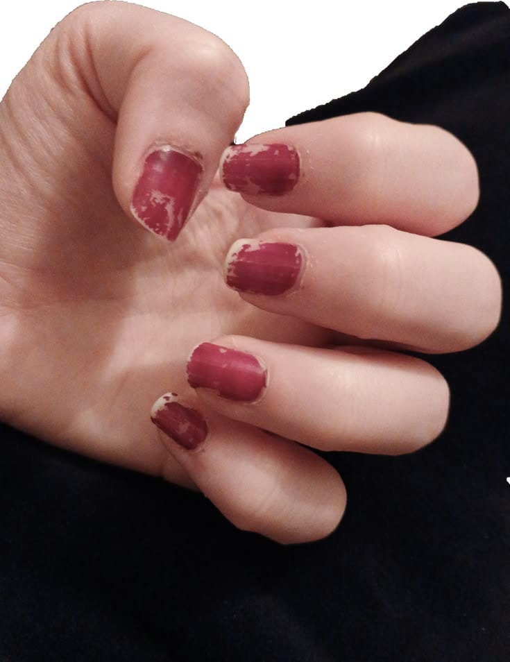 Antes - esmalte desgastado